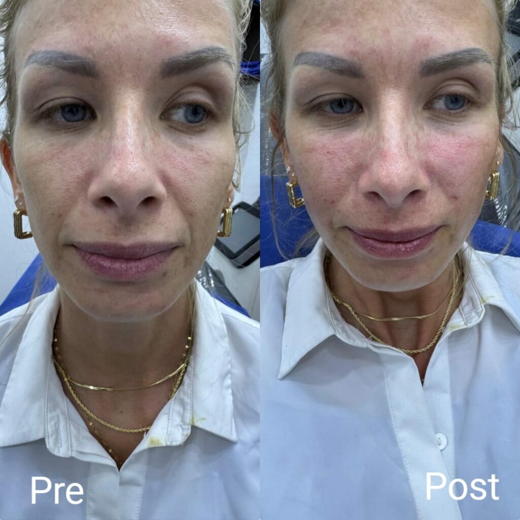 تحسين مظهر الوجه بالفيلر